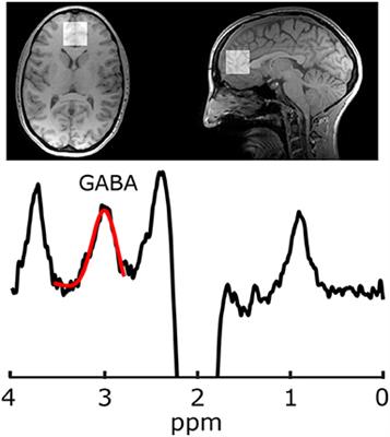 Intermittent Theta-Burst Stimulation Transcranial Magnetic Stimulation Increases GABA in the Medial Prefrontal Cortex: A Preliminary Sham-Controlled Magnetic Resonance Spectroscopy Study in Acute Bipolar Depression